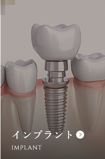 インプラント IMPLANT