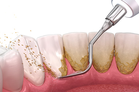 縁下歯石歯石除去