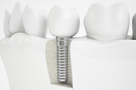 インプラントが支える安定感抜群の入れ歯