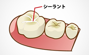 シーラント